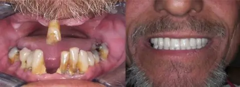 new before and after mouth 480x174