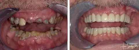 before and after 4 1