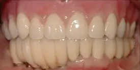 dentures & partial dentures before 2
