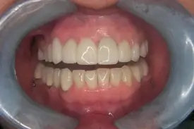 fixed porcelain after 2