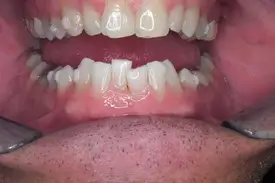 invisalign before 1