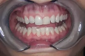 invisalign before 2