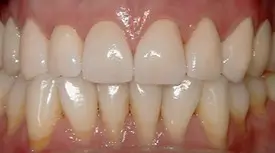 porcelain crowns after 1