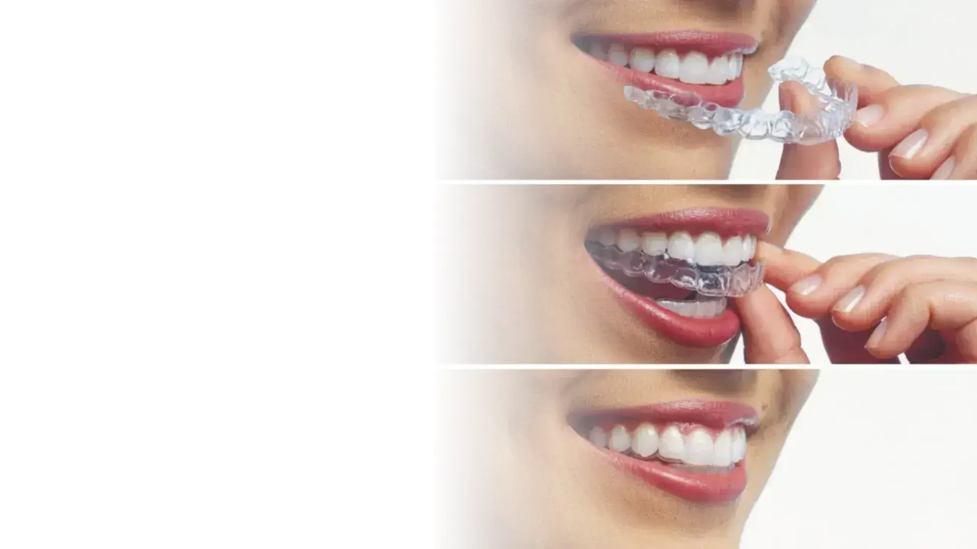 invisalign dcch (1)