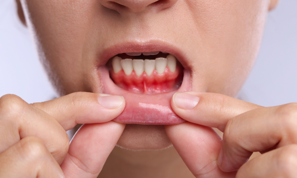 inflamed bleeding gums showing gingivitis symptoms close up Hollywood FL