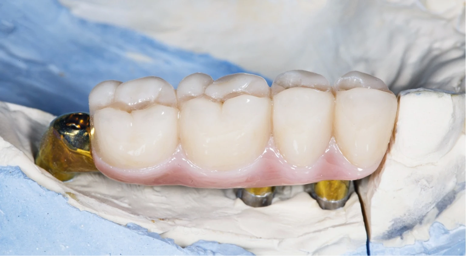 cost of dental implants