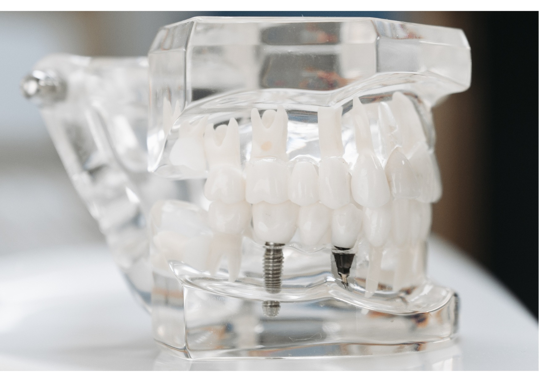 Dental implant model displaying implant posts and replacement teeth used to explain dental implant benefits and limitations