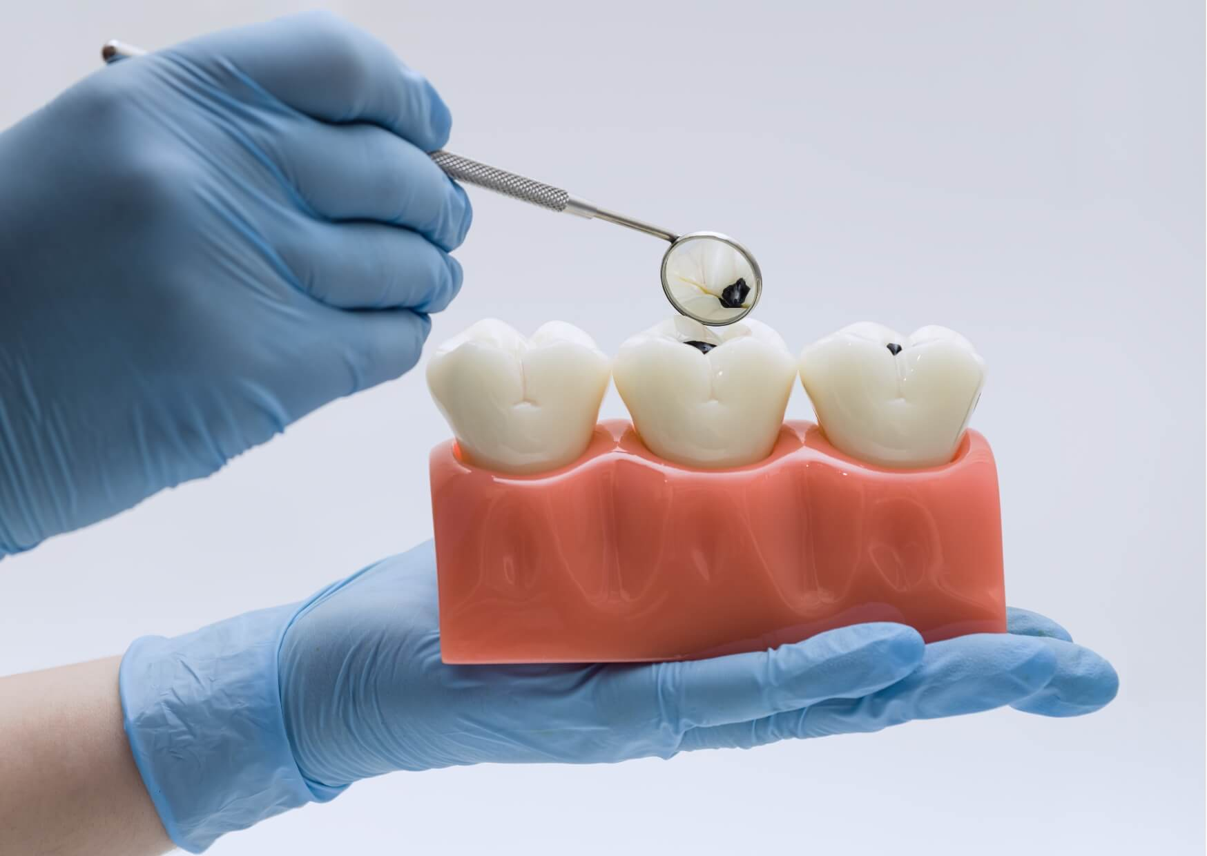 Dental model showing dark spots on tooth surfaces, illustrating what a cavity looks like in its early and visible stages of tooth decay.