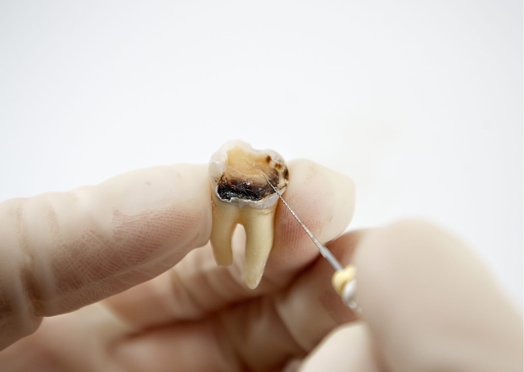 Close-up of a severely decayed tooth with dark brown and black areas, demonstrating what a rotten tooth can look like when tooth decay progresses.