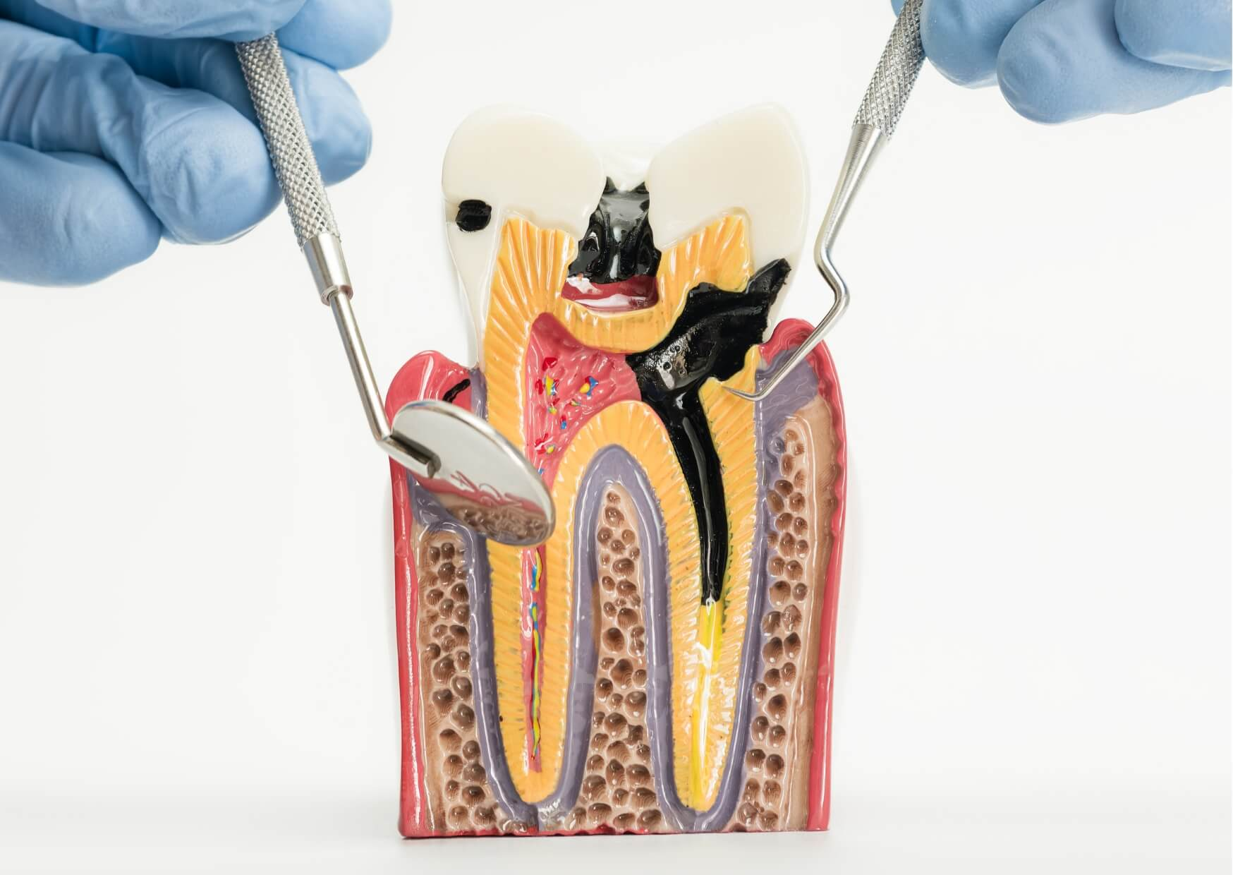 Cross-sectional tooth model showing deep decay reaching the pulp and root, illustrating what an infected tooth looks like beneath the surface.