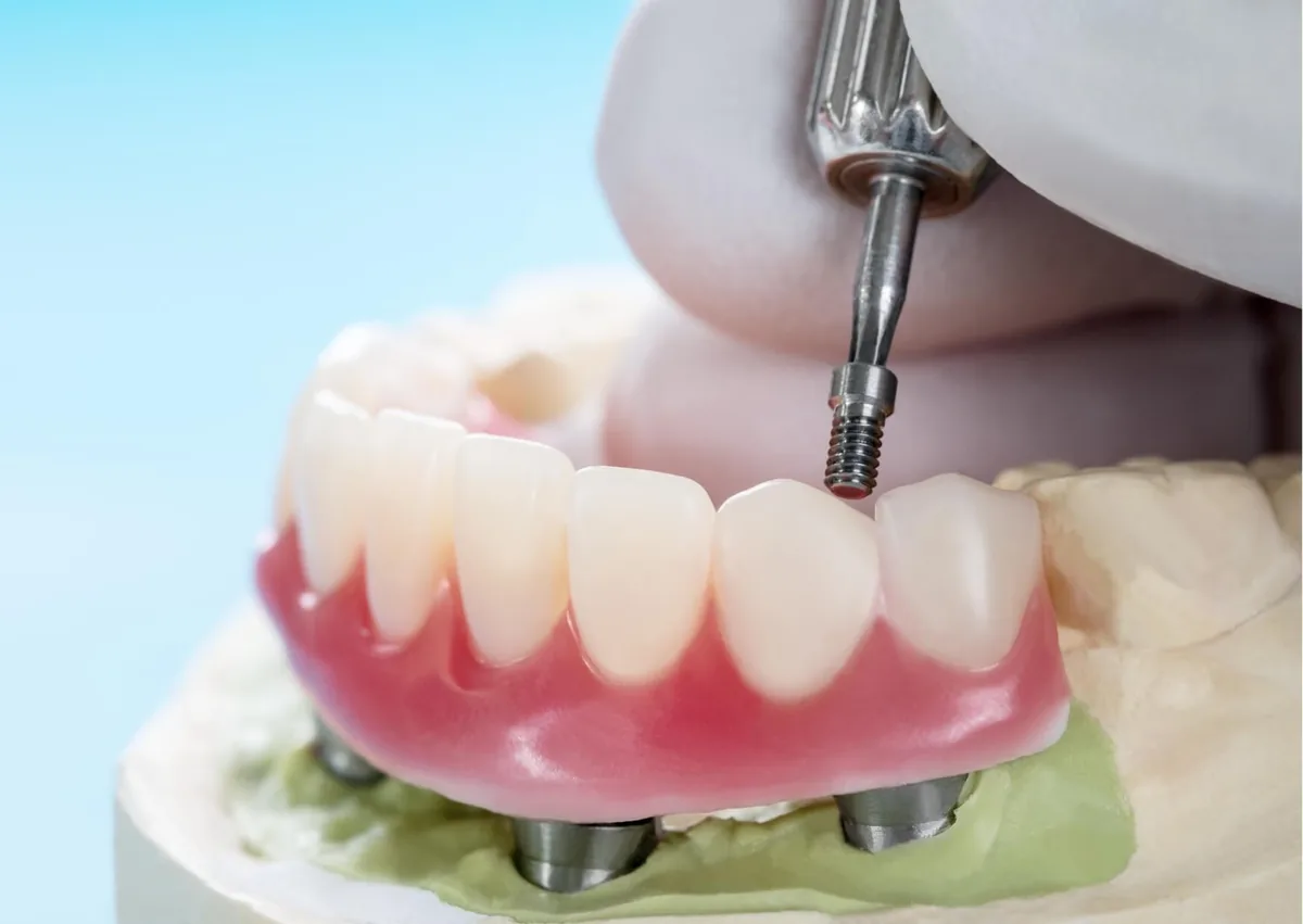 Dental implant model showing a full arch restoration supported by implants, illustrating full mouth dental implants and cost considerations.