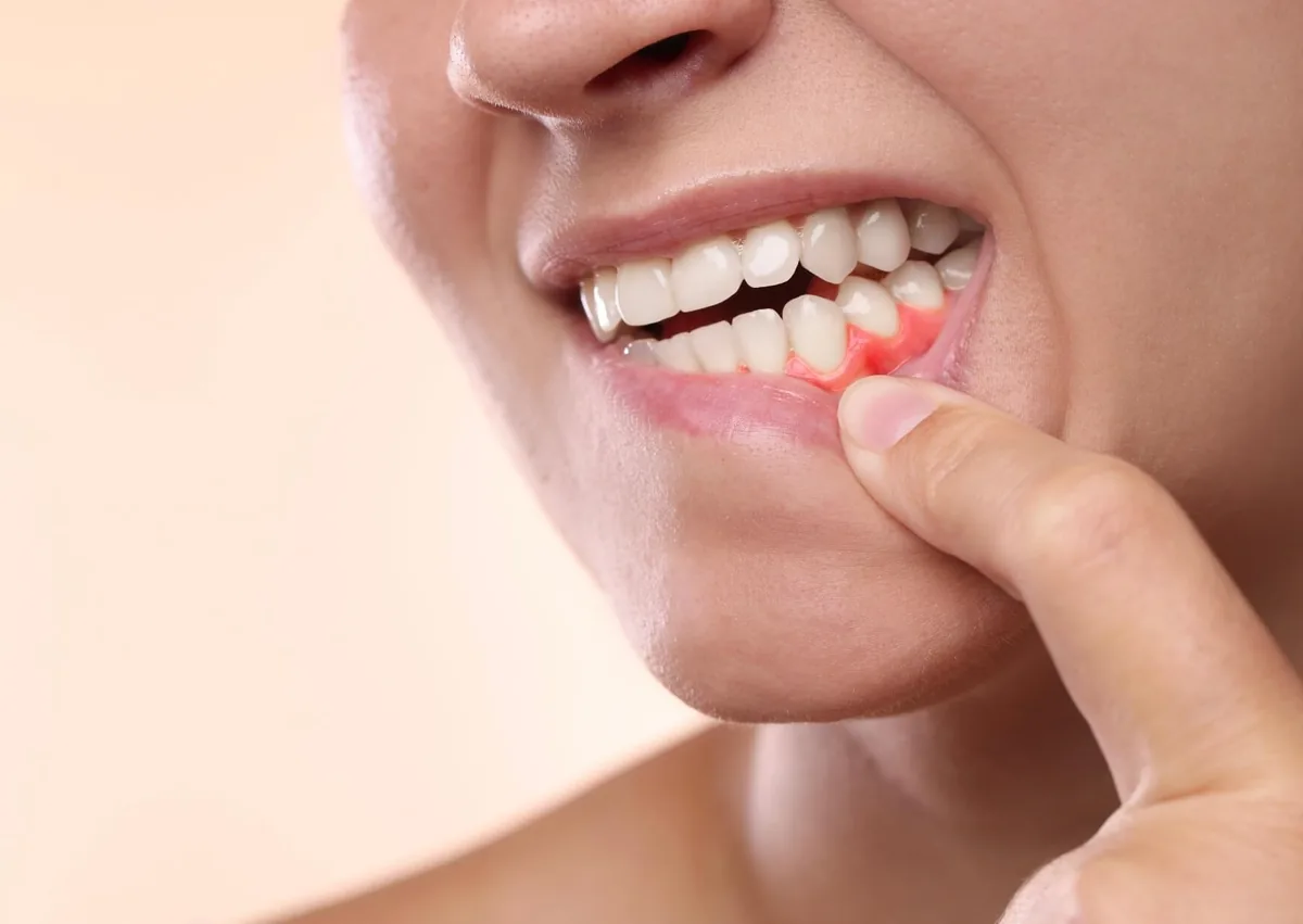 Close-up of receding and irritated gums exposing more of the teeth near the gumline.