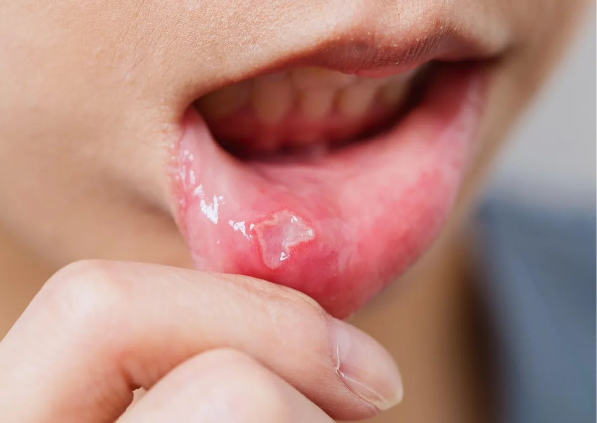 Close-up of a canker sore inside the lower lip showing the mouth ulcer during healing.
