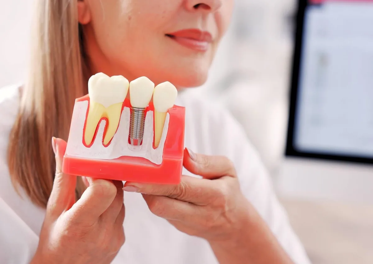 Dental implant model showing how an affordable dental implant replaces a missing tooth and supports a dental crown.