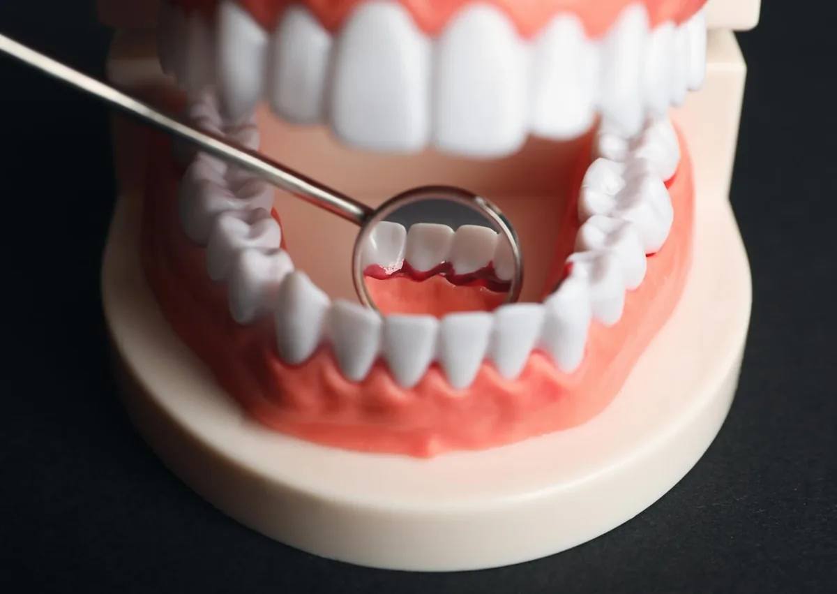 Dental model showing inflamed gums to illustrate differences between gingivitis and periodontitis.
