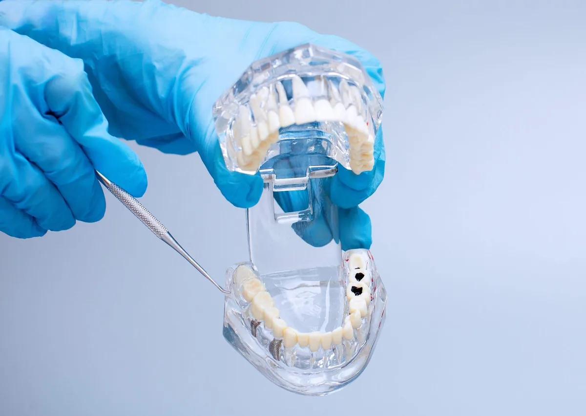 Dental model showing dark spots on molars to demonstrate what cavities can look like on teeth.